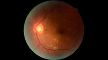 CIENCIA Y SALUD. Retinar: la inteligencia artificial desarrollada por investigadores del CONICET que busca prevenir la pérdida visual en personas con diabetes